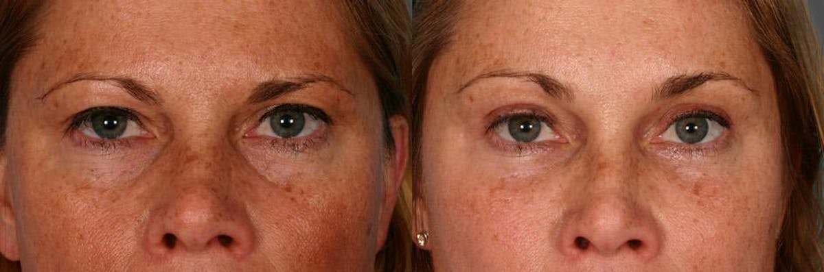 Eyelid Surgery (Blepharoplasty) Before & After Gallery - Patient 244078 - Image 4
