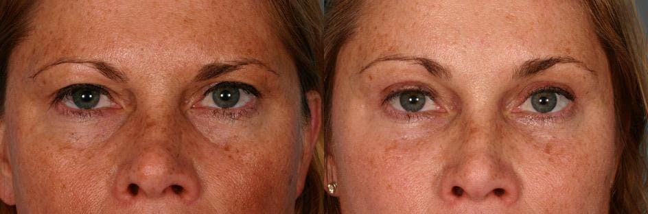 Eyelid Surgery (Blepharoplasty) Before & After Gallery - Patient 244078 - Image 4