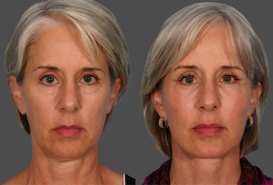 Facial Fat Transfer Before & After Gallery - Patient 154553 - Image 1