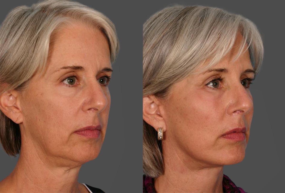 Facial Fat Transfer Before & After Gallery - Patient 154553 - Image 2