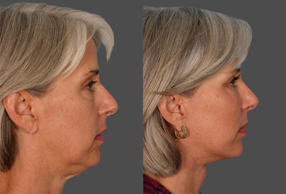 Facial Fat Transfer Before & After Gallery - Patient 154553 - Image 3
