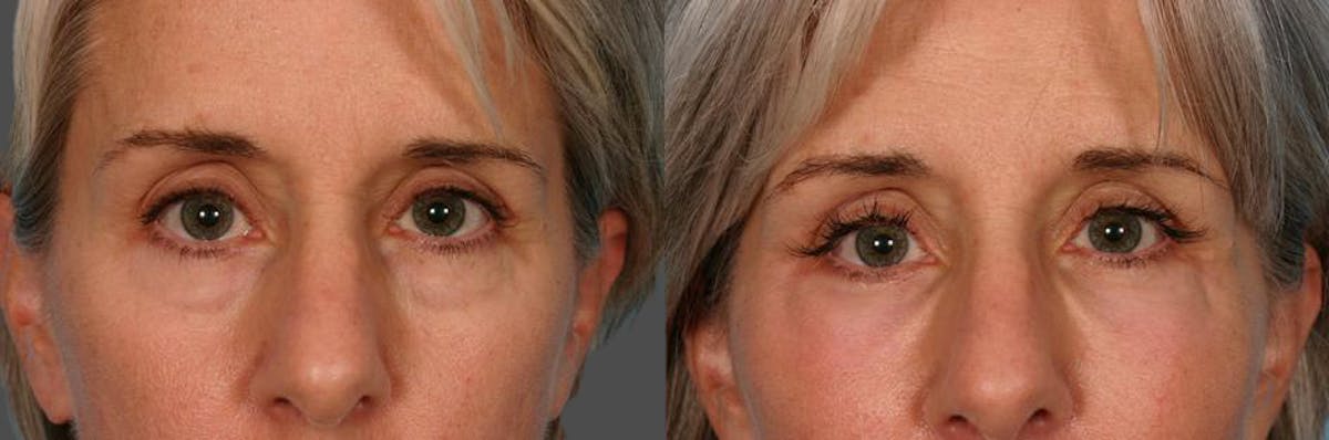 Facial Fat Transfer Before & After Gallery - Patient 154553 - Image 4