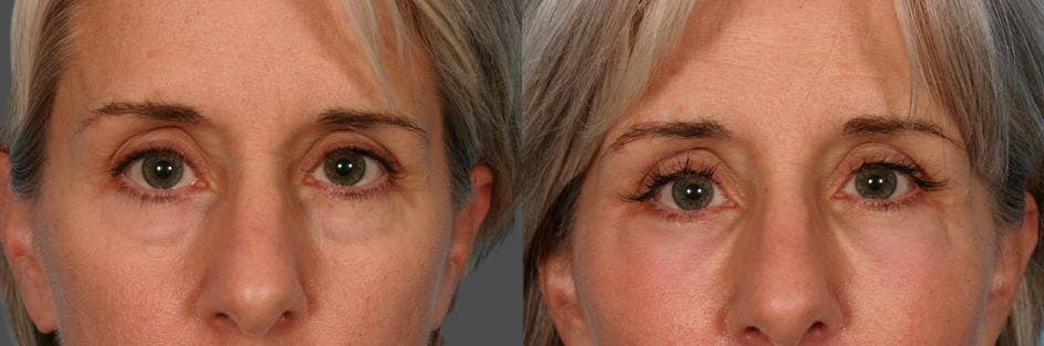 Facial Fat Transfer Before & After Gallery - Patient 154553 - Image 4