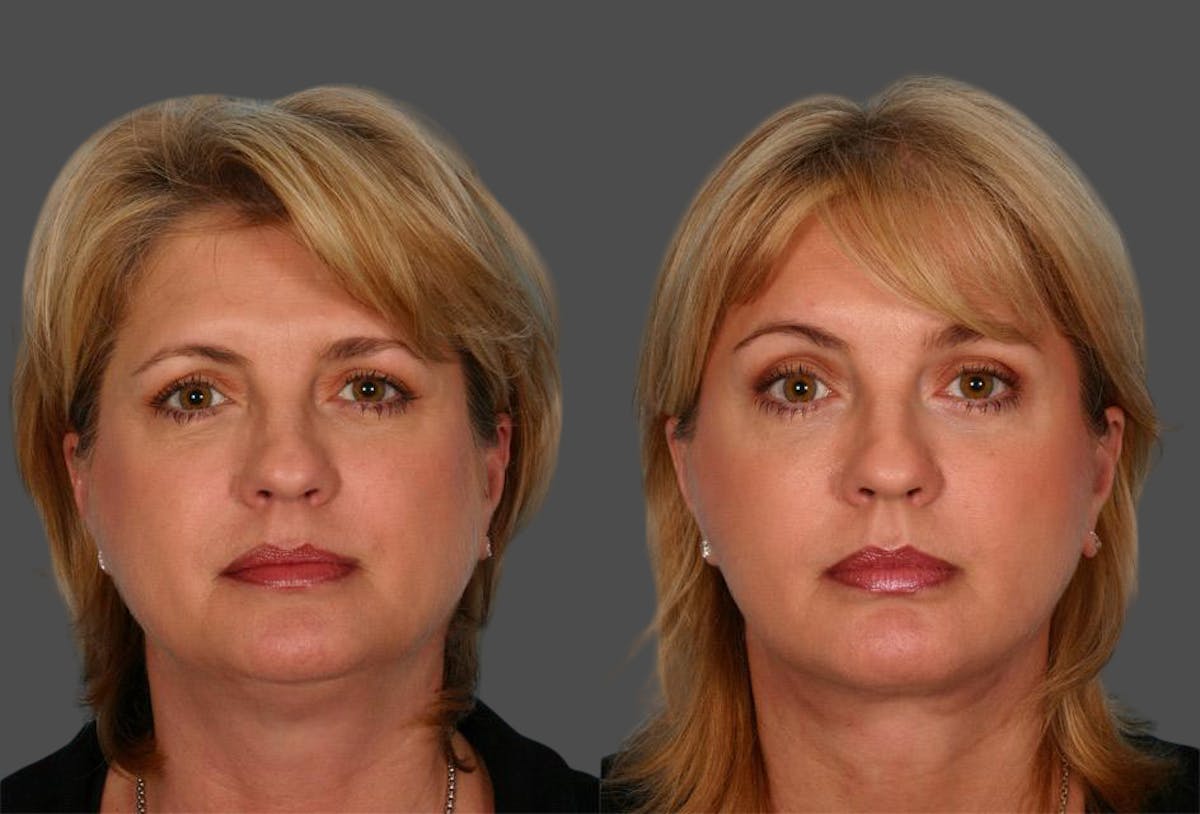 Eyelid Surgery (Blepharoplasty) Before & After Gallery - Patient 294301 - Image 1