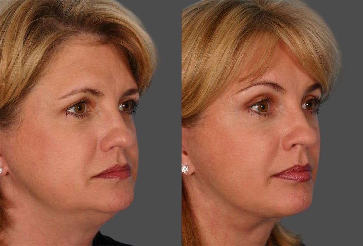 Eyelid Surgery (Blepharoplasty) Before & After Gallery - Patient 294301 - Image 2