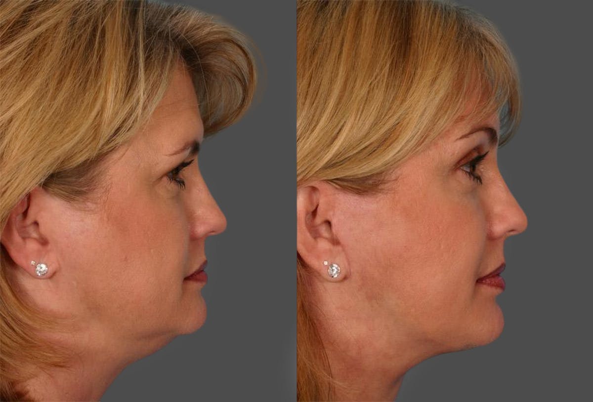 Eyelid Surgery (Blepharoplasty) Before & After Gallery - Patient 294301 - Image 3