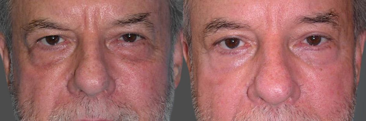 Eyelid Surgery (Blepharoplasty) Before & After Gallery - Patient 289617 - Image 1
