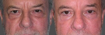 Eyelid Surgery (Blepharoplasty) Before & After Gallery - Patient 289617 - Image 1