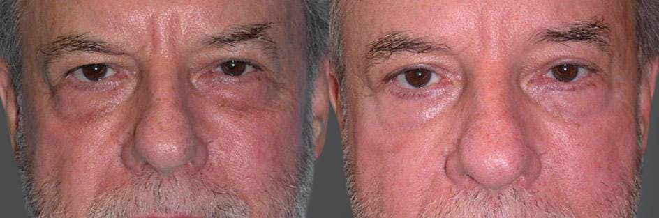 Eyelid Surgery (Blepharoplasty) Before & After Gallery - Patient 289617 - Image 1