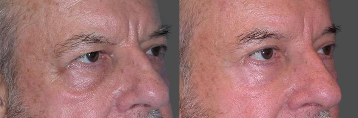 Eyelid Surgery (Blepharoplasty) Before & After Gallery - Patient 289617 - Image 2