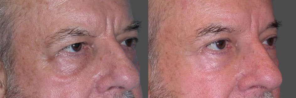 Eyelid Surgery (Blepharoplasty) Before & After Gallery - Patient 289617 - Image 2