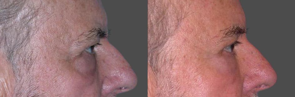Eyelid Surgery (Blepharoplasty) Before & After Gallery - Patient 289617 - Image 3