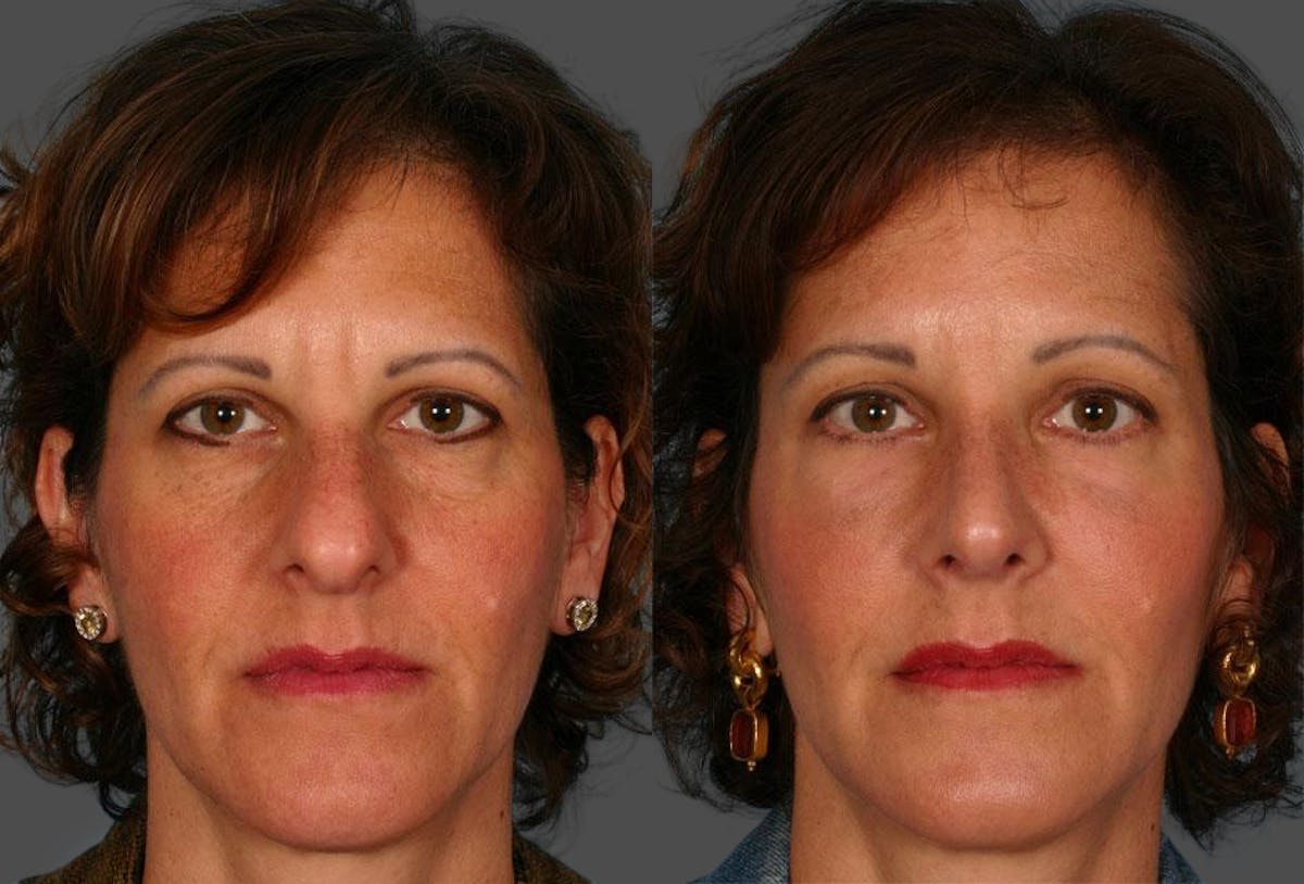 Facial Fat Transfer Before & After Gallery - Patient 468574 - Image 1