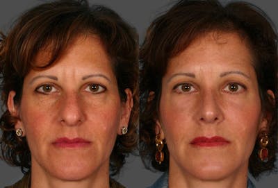 Eyelid Surgery (Blepharoplasty) Before & After Gallery - Patient 283287 - Image 1