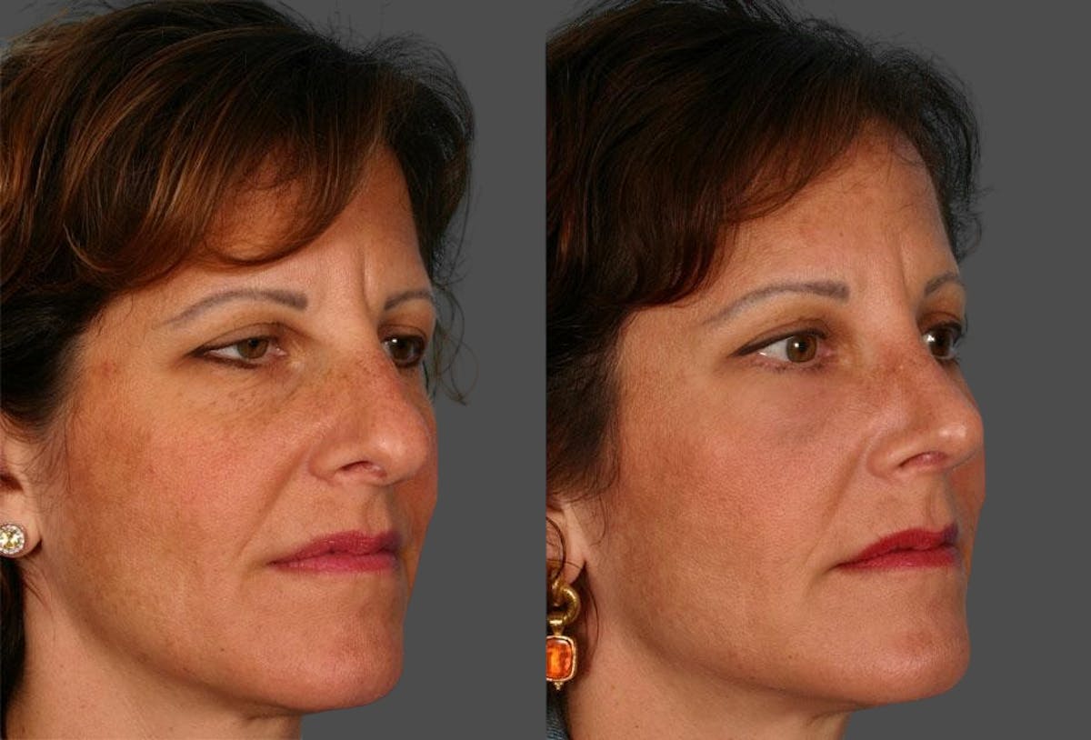 Facial Fat Transfer Before & After Gallery - Patient 468574 - Image 2