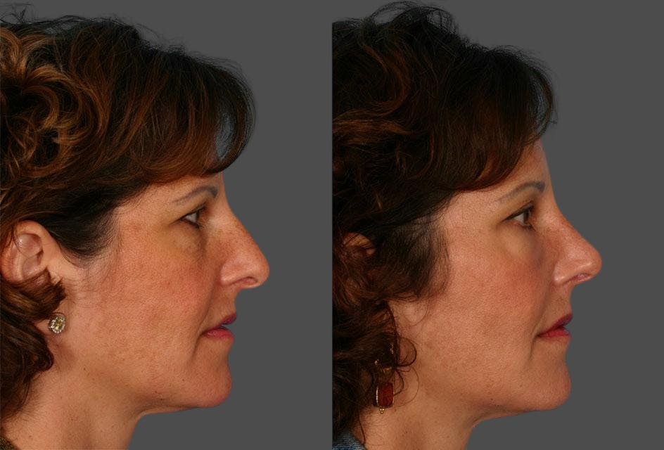 Facial Fat Transfer Before & After Gallery - Patient 468574 - Image 3