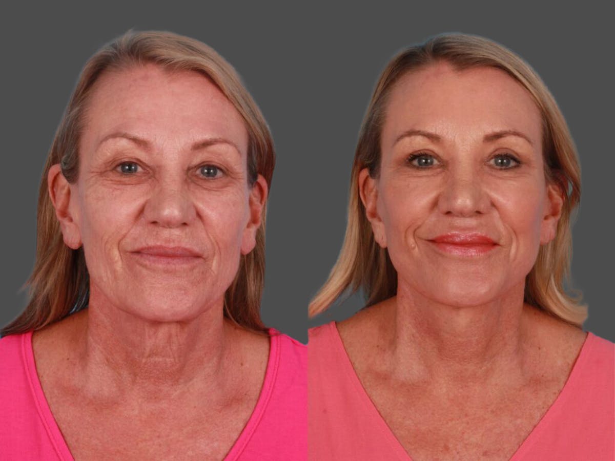 TCA Peel / Dermabrasion Before & After Gallery - Patient 217969 - Image 1