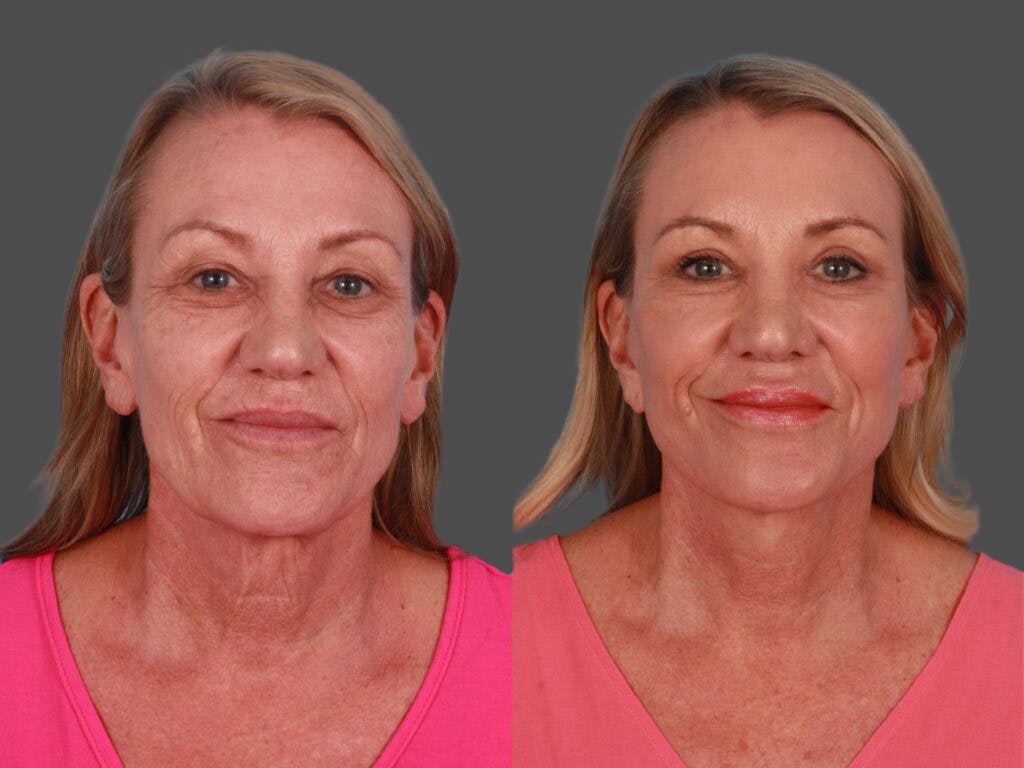 TCA Peel / Dermabrasion Before & After Gallery - Patient 217969 - Image 1