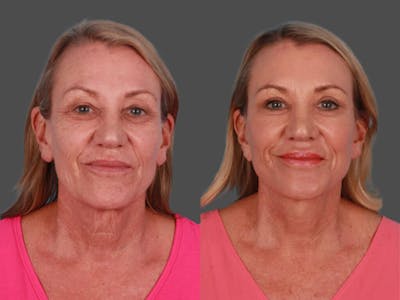 Eyelid Surgery (Blepharoplasty) Before & After Gallery - Patient 317385 - Image 1