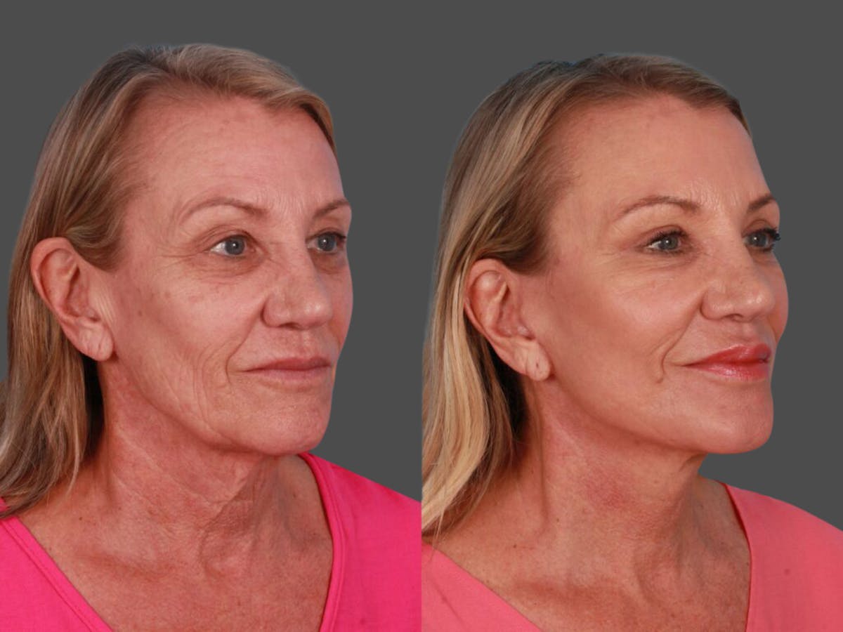 TCA Peel / Dermabrasion Before & After Gallery - Patient 217969 - Image 2
