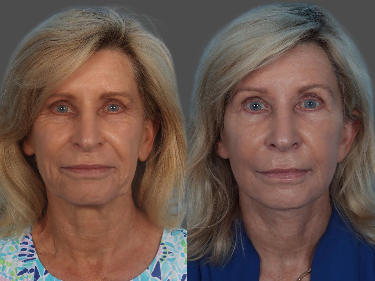 Facelift Before & After Gallery - Patient 160984 - Image 1