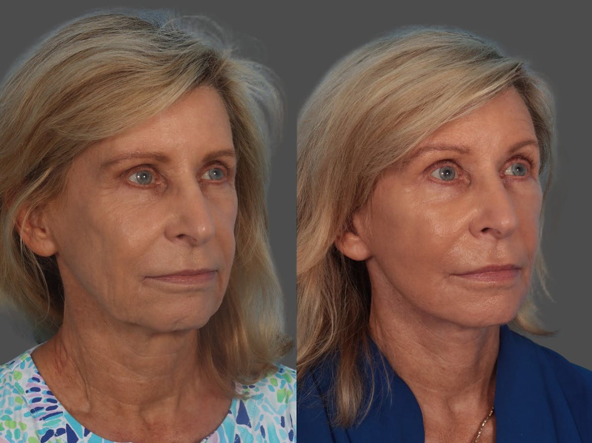 Facelift Before & After Gallery - Patient 160984 - Image 2