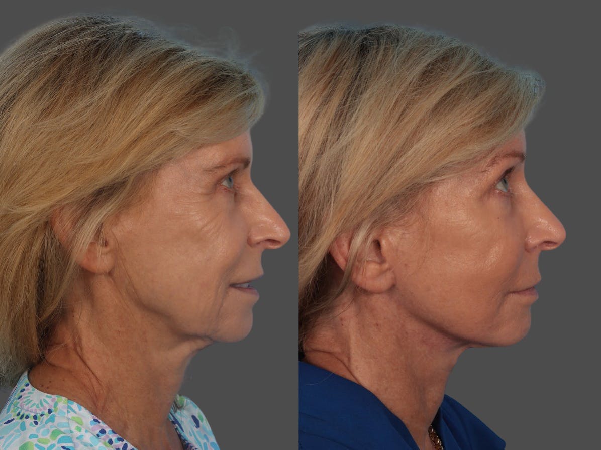 Facelift Before & After Gallery - Patient 160984 - Image 3
