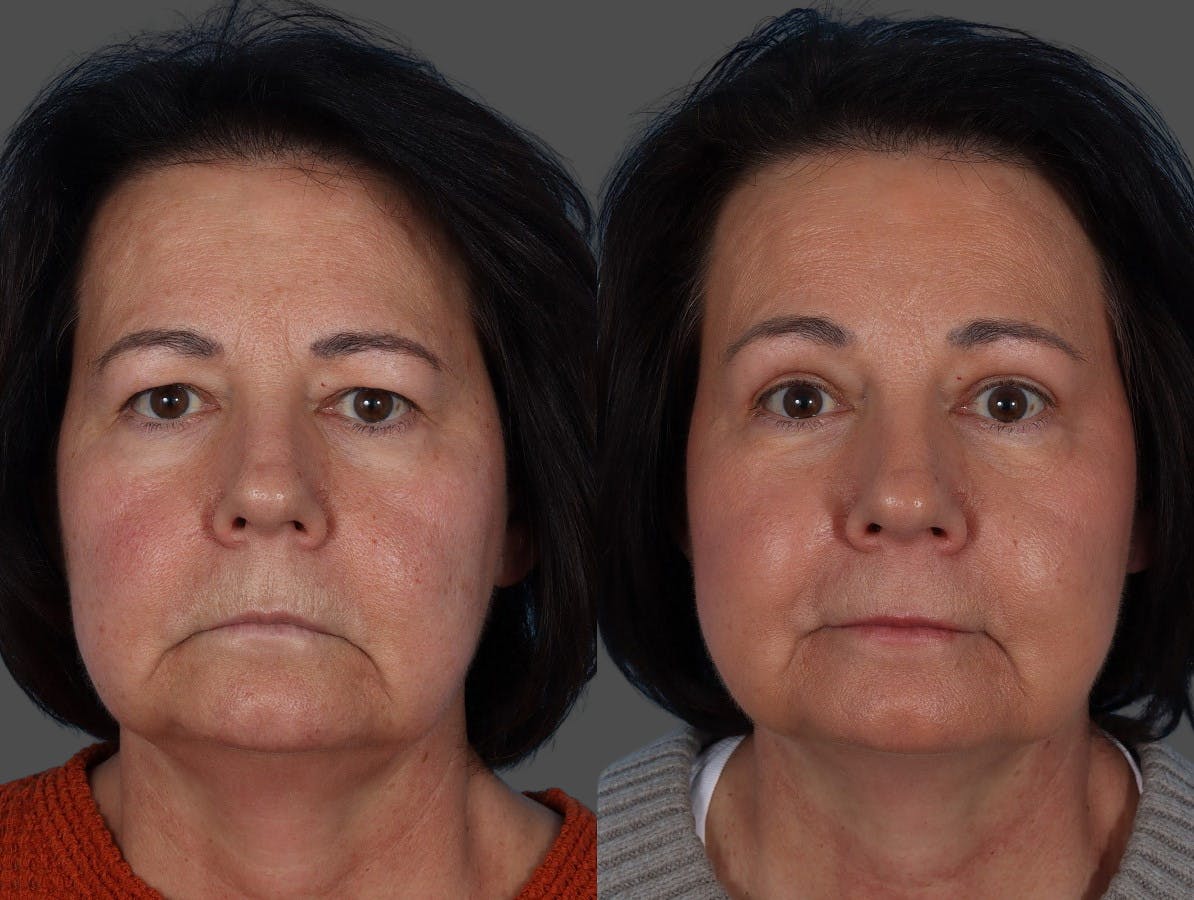 Eyelid Surgery (Blepharoplasty) Before & After Gallery - Patient 285727 - Image 1