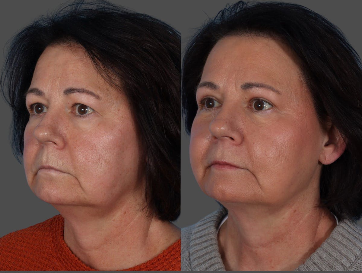 Eyelid Surgery (Blepharoplasty) Before & After Gallery - Patient 285727 - Image 2