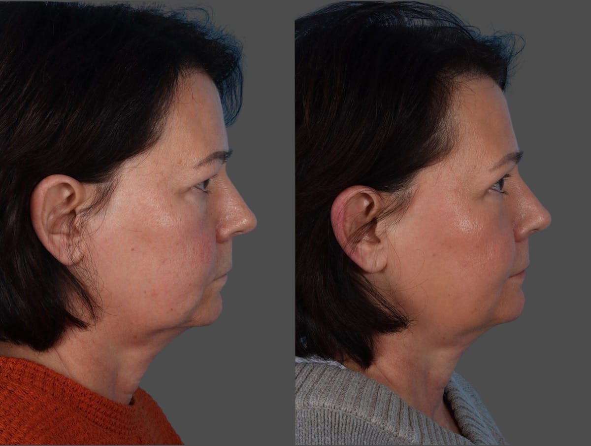 Eyelid Surgery (Blepharoplasty) Before & After Gallery - Patient 285727 - Image 3