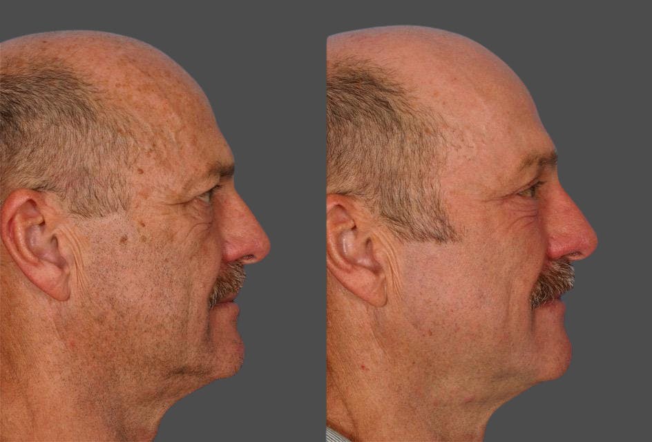 TCA Peel / Dermabrasion Before & After Gallery - Patient 222260 - Image 3