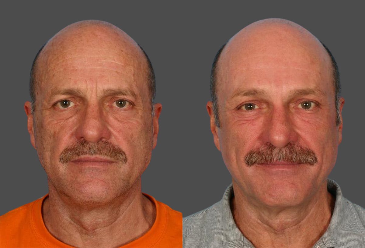 TCA Peel / Dermabrasion Before & After Gallery - Patient 222260 - Image 1