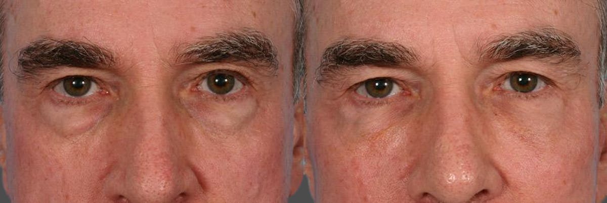 Facelift Before & After Gallery - Patient 353293 - Image 4