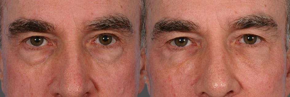 Facelift Before & After Gallery - Patient 353293 - Image 4