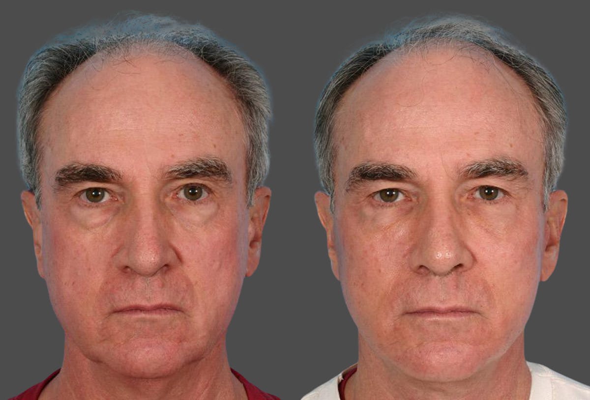 Facelift Before & After Gallery - Patient 353293 - Image 1