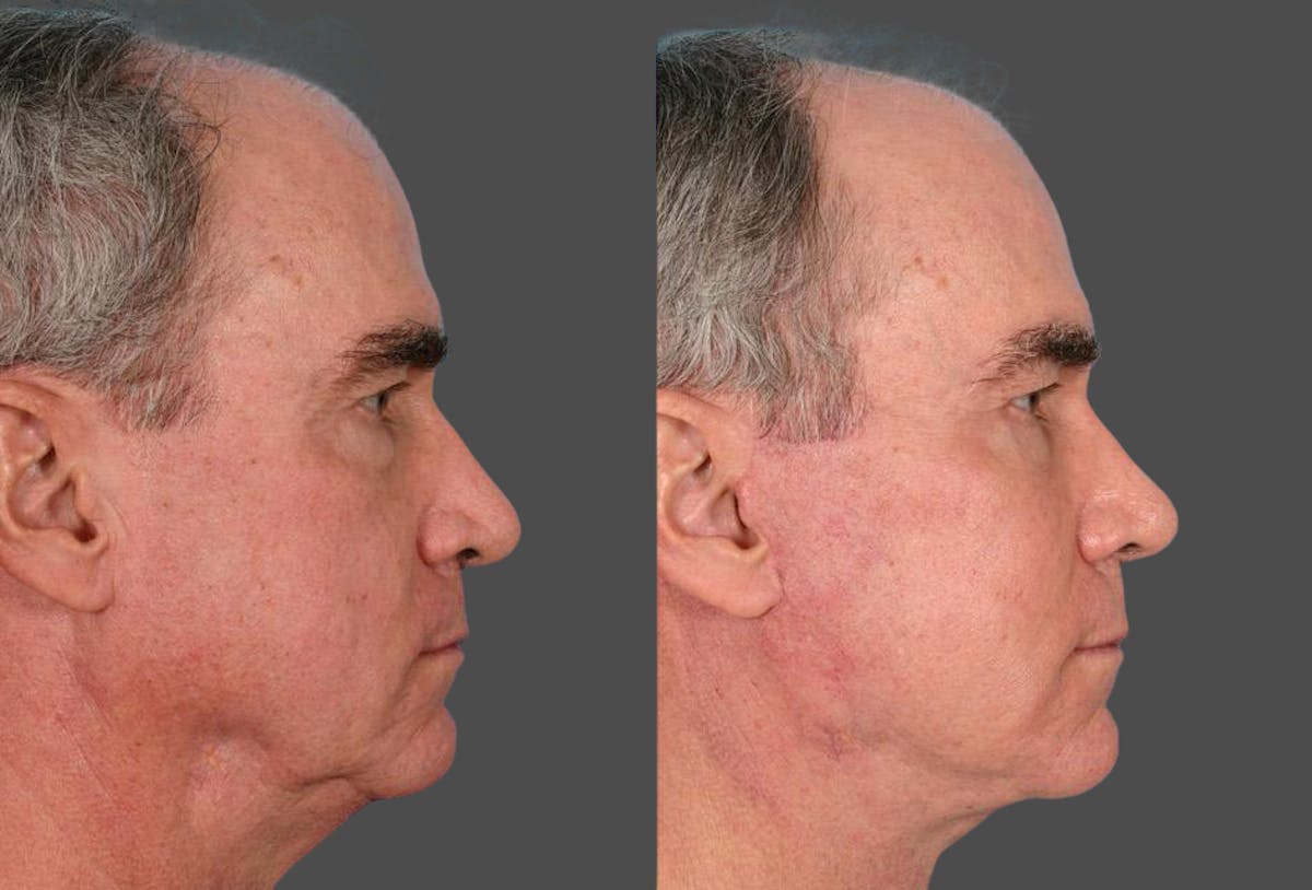 Facelift Before & After Gallery - Patient 353293 - Image 3