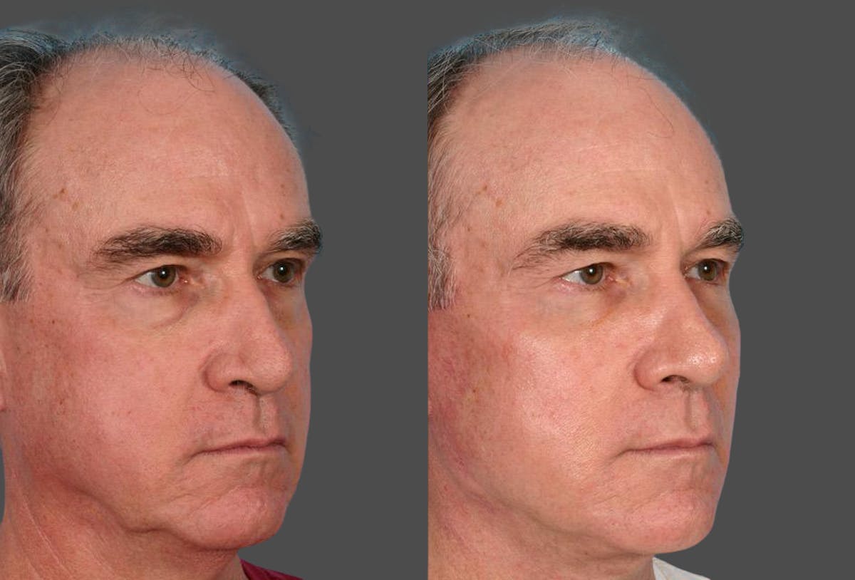 Facelift Before & After Gallery - Patient 353293 - Image 2