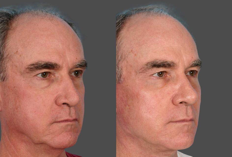Facelift Before & After Gallery - Patient 353293 - Image 2