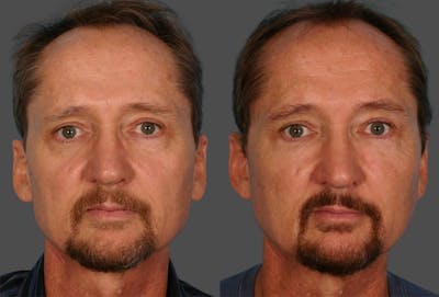 Eyelid Surgery (Blepharoplasty) Before & After Gallery - Patient 109927 - Image 1
