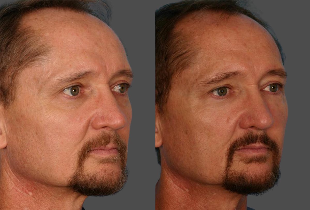 Facial Fat Transfer Before & After Gallery - Patient 421566 - Image 2