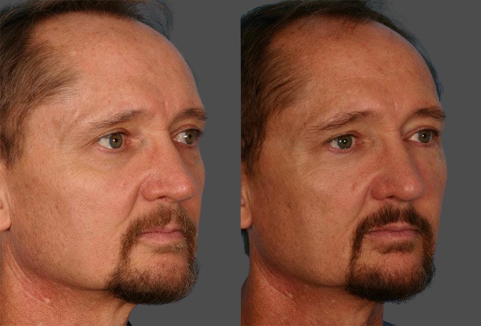 Facial Fat Transfer Before & After Gallery - Patient 421566 - Image 2