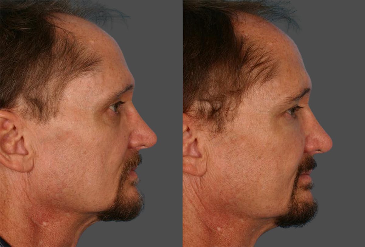 Facial Fat Transfer Before & After Gallery - Patient 421566 - Image 3