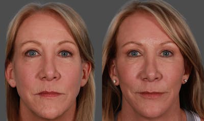 Eyelid Surgery (Blepharoplasty) Before & After Gallery - Patient 169878 - Image 1