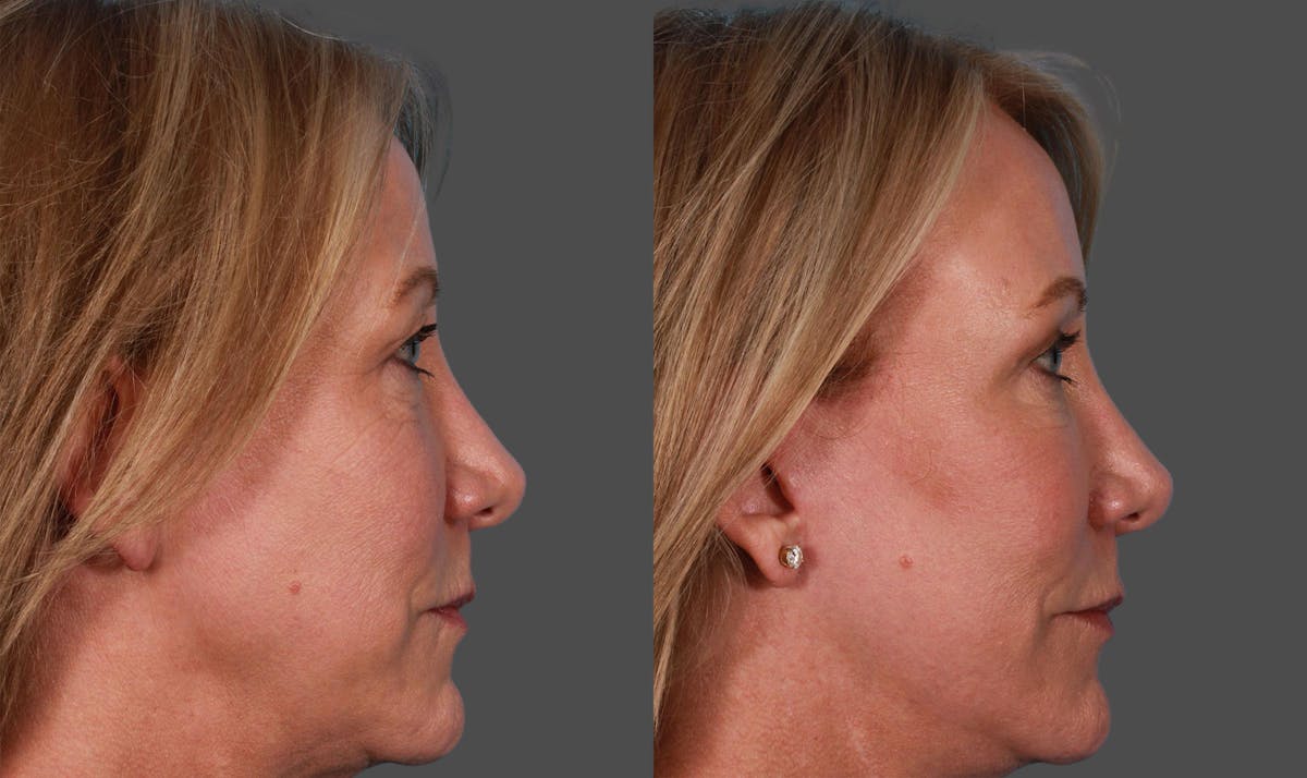 Eyelid Surgery (Blepharoplasty) Before & After Gallery - Patient 169878 - Image 2