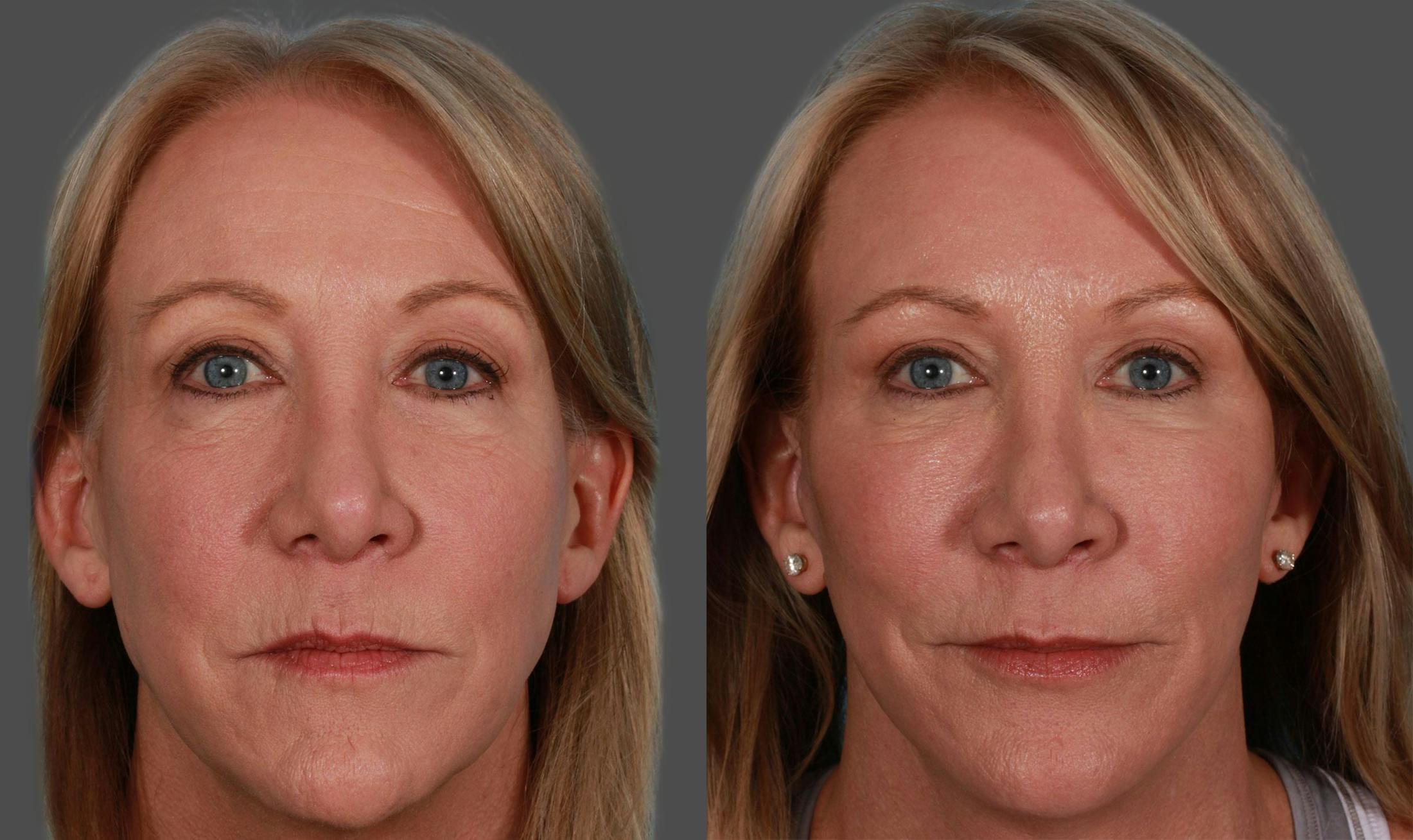 TCA Peel / Dermabrasion Before & After Gallery - Patient 730576 - Image 1