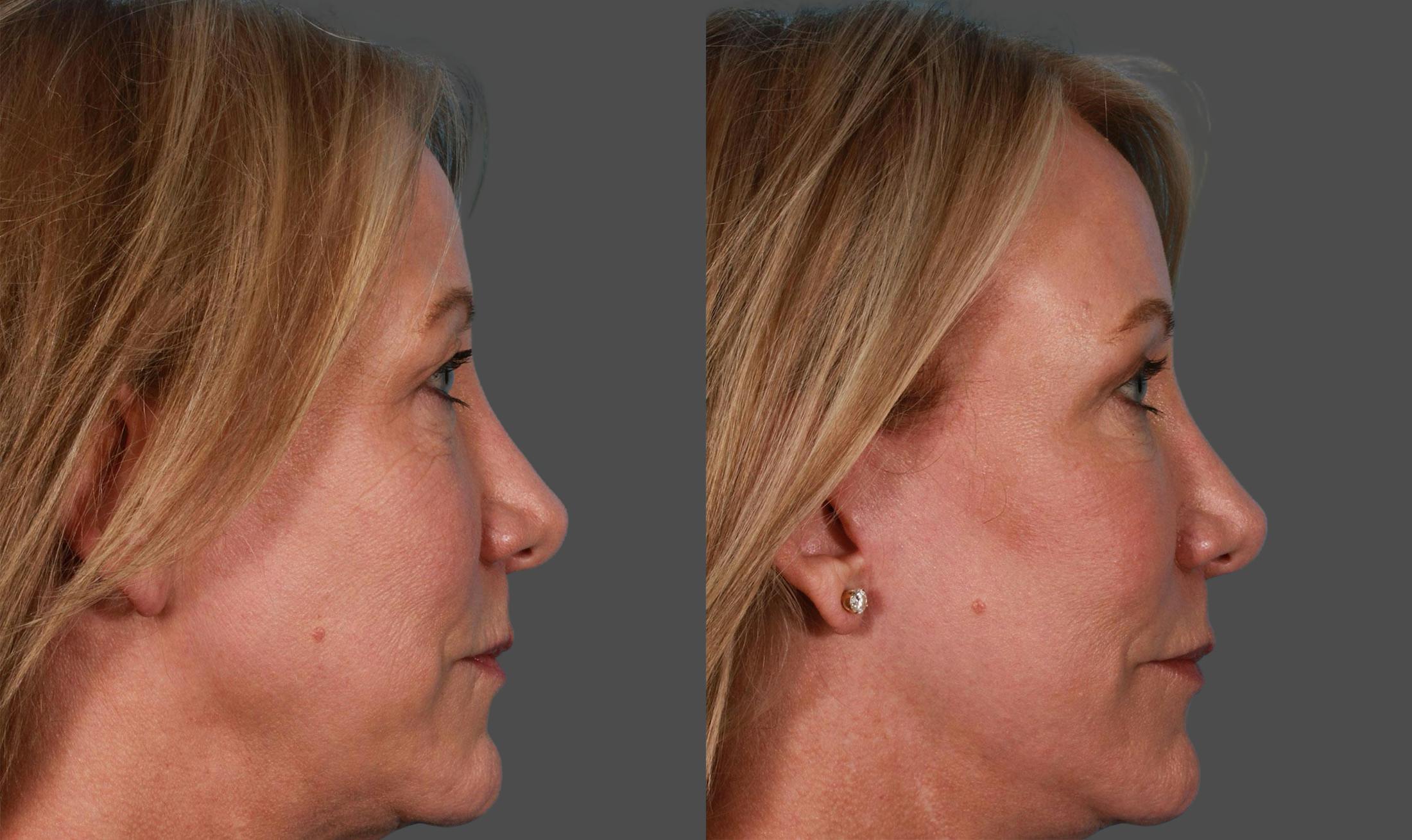TCA Peel / Dermabrasion Before & After Gallery - Patient 730576 - Image 2