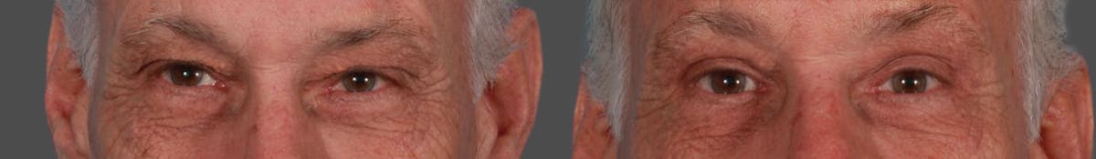Eyelid Surgery (Blepharoplasty) Before & After Gallery - Patient 354993 - Image 2