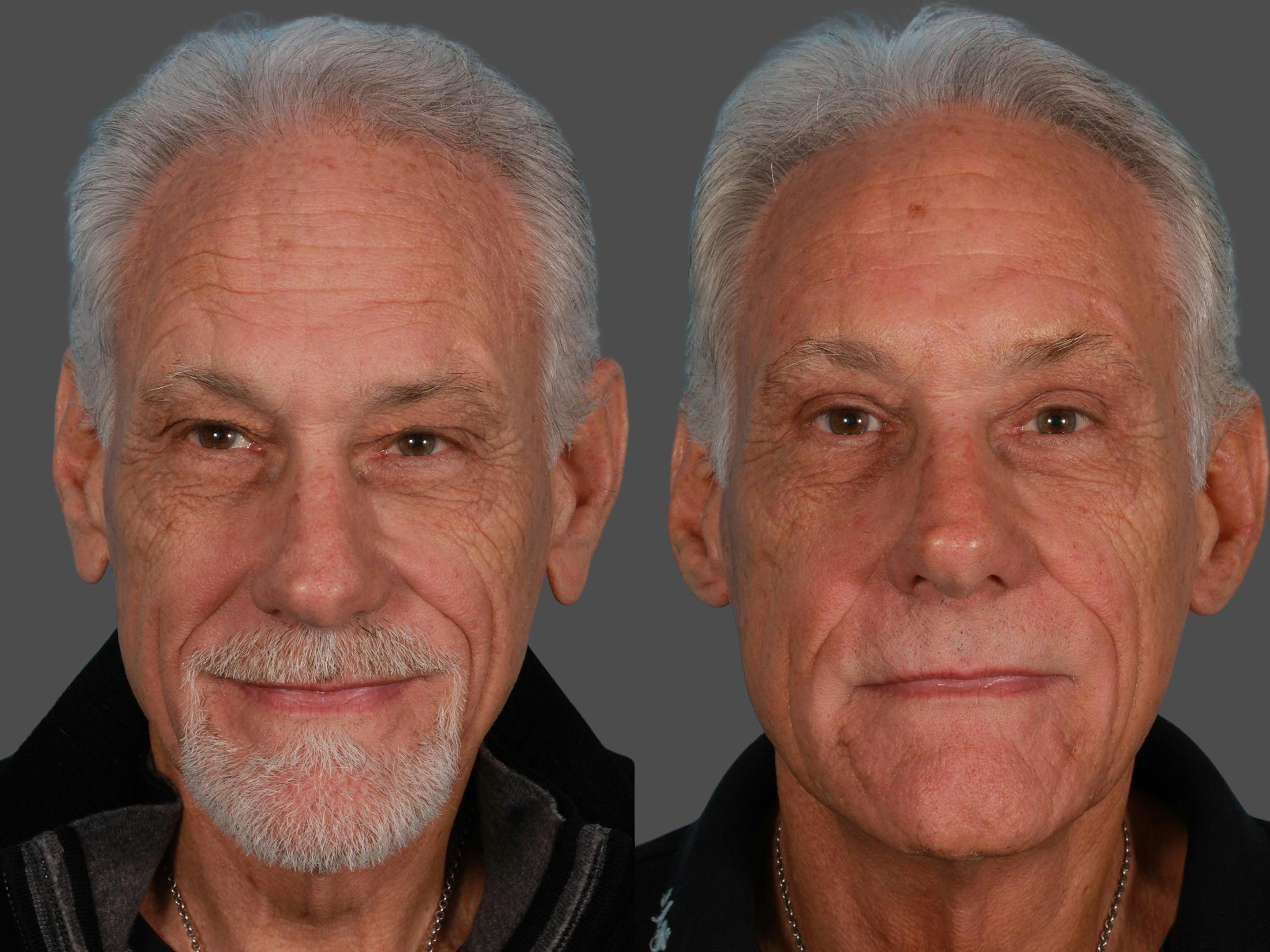 Eyelid Surgery (Blepharoplasty) Before & After Gallery - Patient 354993 - Image 1
