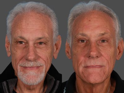 Eyelid Surgery (Blepharoplasty) Before & After Gallery - Patient 354993 - Image 1