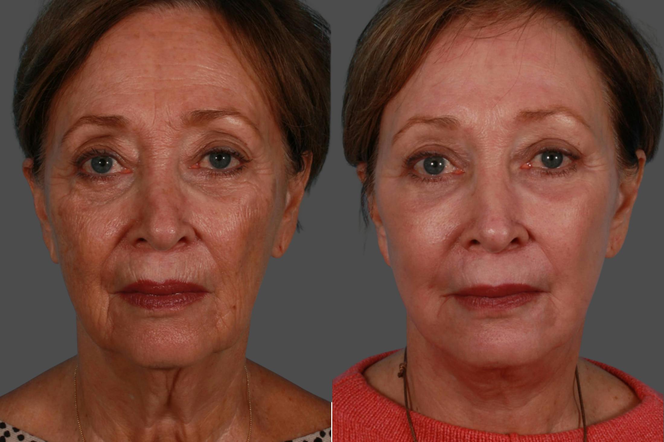 Eyelid Surgery (Blepharoplasty) Before & After Gallery - Patient 138534 - Image 1